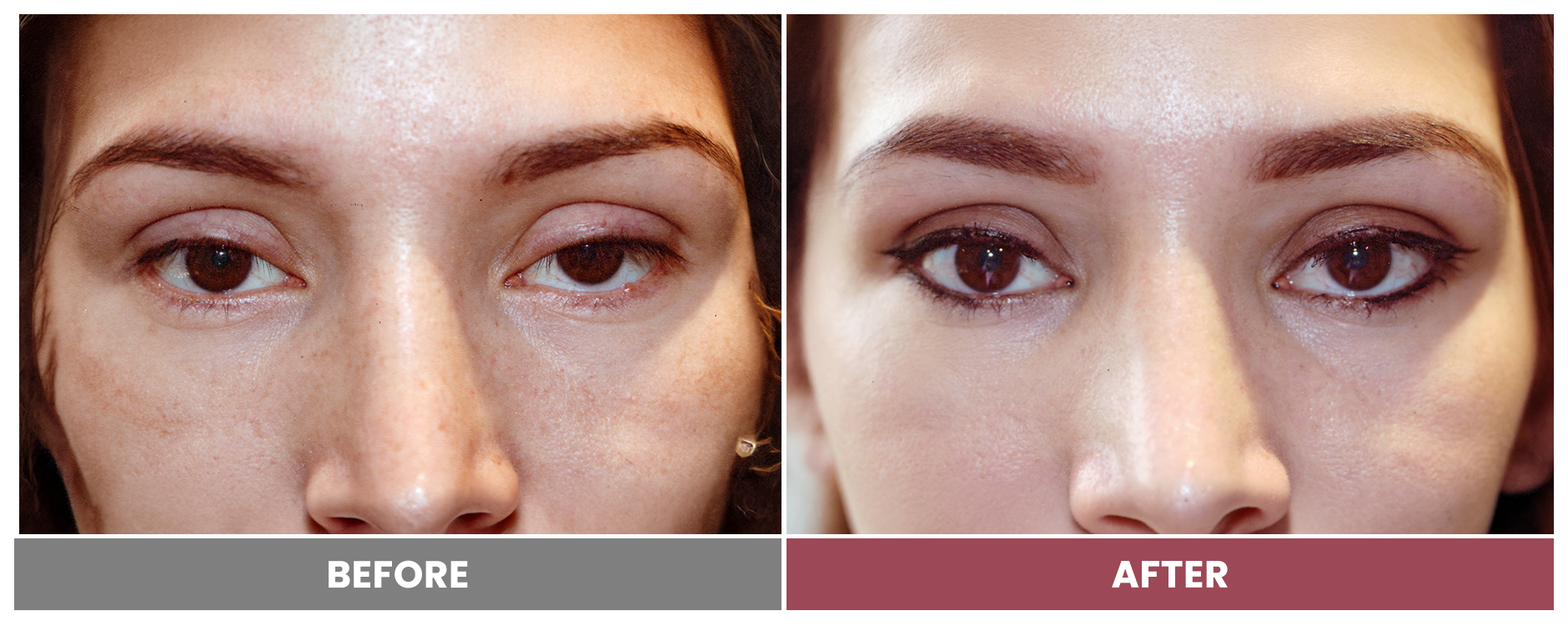 PTOSIS REPAIR - Case 25